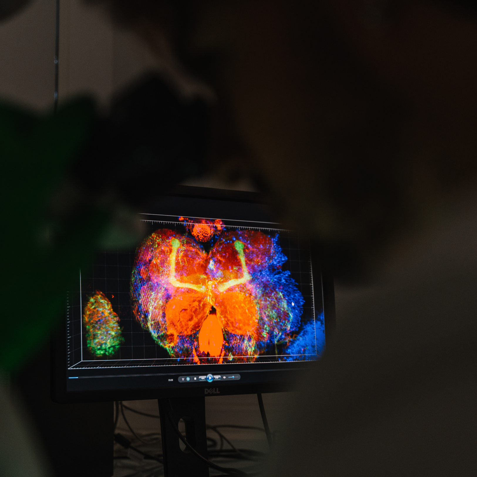 Une avancée dans la recherche contre la maladie dʼAlzheimer par des chercheurs lillois