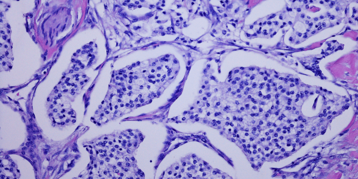 Comprendre la forme neuroendocrine du cancer de la prostate